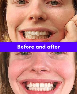 Smile Direct Club New Smile Kit