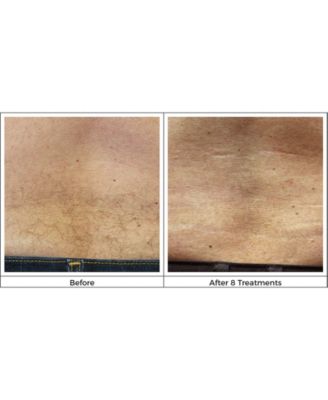 Silk'N Infinity Hair Removal Device