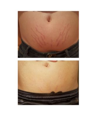 Stretchmark Device
