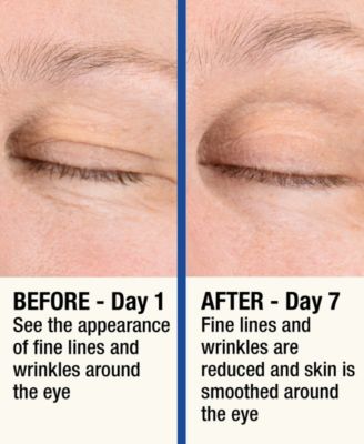 ReMOVE Micro Dermabrasion Device with Cooling Surface