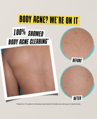 Expertly Clear Acne-Treating & Preventing Lotion