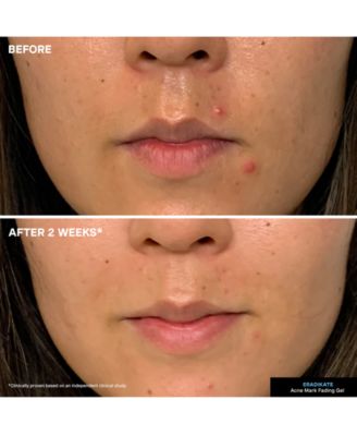 EradiKate Acne Mark Fading Gel, 1 oz.