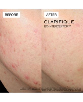 Clarifique Bx-Interceptor Acne Treatment, 1 oz.