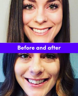 Smile Direct Club New Smile Kit