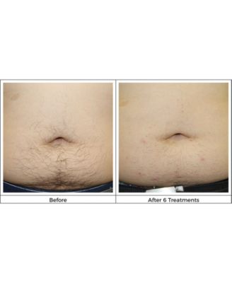 Silk'N Infinity Hair Removal Device