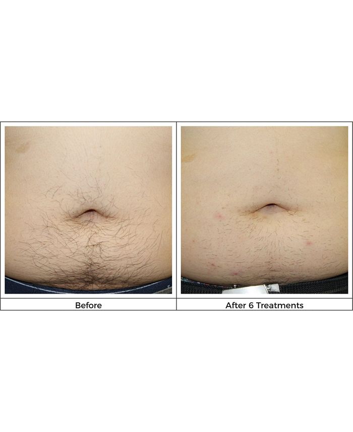 Silk'N Infinity Hair Removal Device Macy's