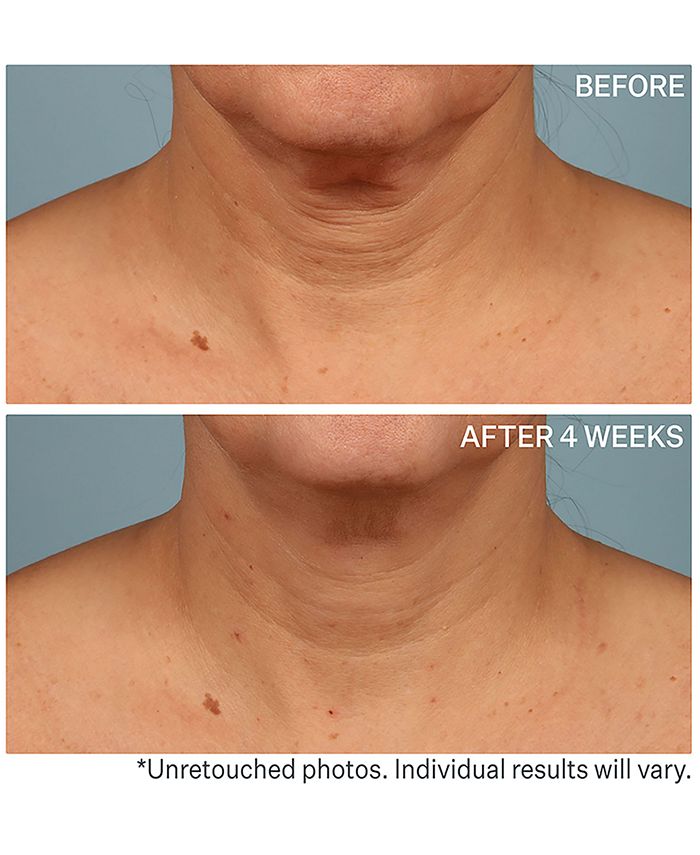 top 91+ Pictures strivectin neck cream before and after photos Full HD, 2k, 4k