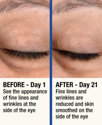 ReMOVE Micro Dermabrasion Device with Cooling Surface