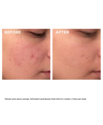 Beauty Flash Peel with BHA & AHA