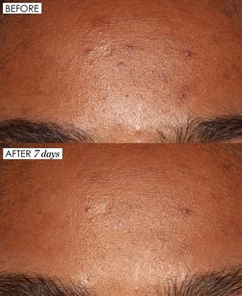 Sunday Riley - Good Genes All-In-One Lactic Acid Treatment