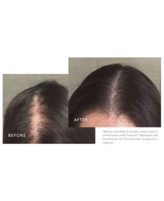 Minoxidil Topical Aerosol 5%, 2.11 oz.