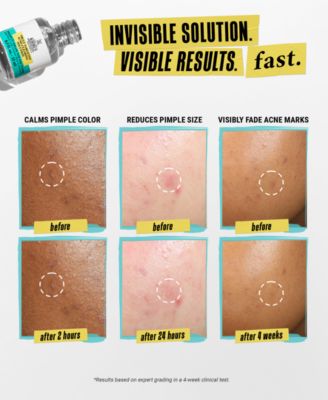 Truly Targeted Acne-Clearing Solution