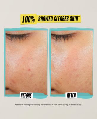 Expertly Clear Acne-Treating & Preventing Lotion