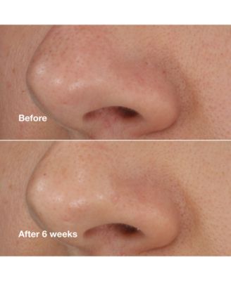 Blackhead Solutions Self-Heating Blackhead Extractor with Salicylic Acid, 0.68 oz.