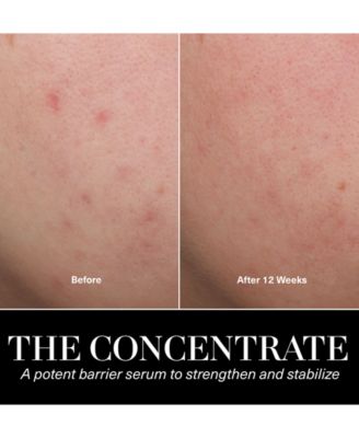 The Treatment Lotion, 5 oz.