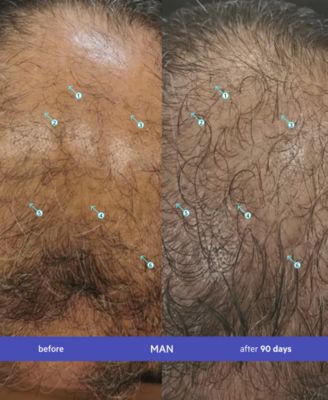 Spectral.UHP Men's Extra Strength Regrowth Treatment With Minoxidil 5%, 3-Month Supply