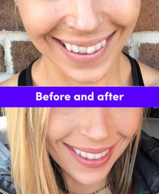 Smile Direct Club New Smile Kit