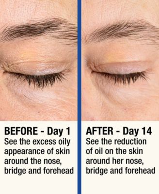 ReMOVE Micro Dermabrasion Device with Cooling Surface