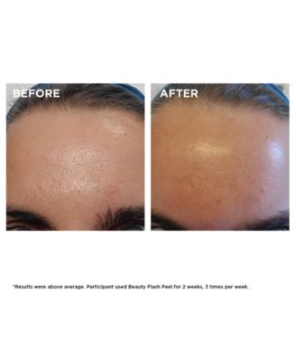 Beauty Flash Peel with BHA & AHA