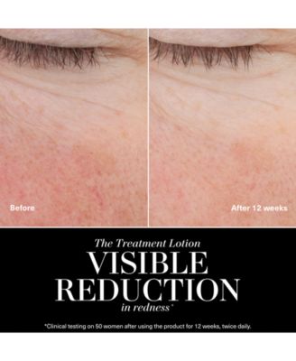 The Treatment Lotion, 5 oz.