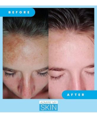 Dark Spot Corrector Remover for Face Ultra Potent Brightening Serum