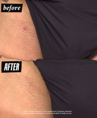 Ingrown Hair & Tone-Correcting Intimate Drops