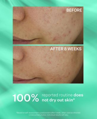 3-Pc. Acne Control Trial Set