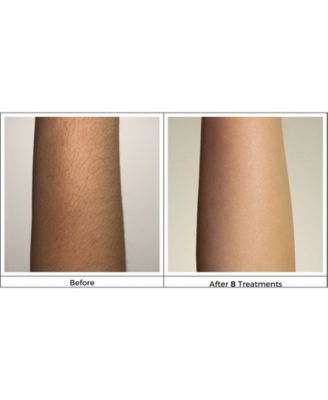 Silk'N Infinity Hair Removal Device