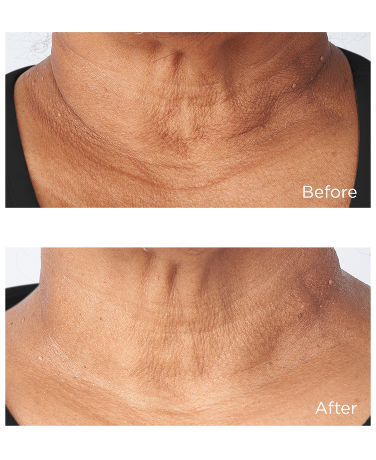 Perricone Md Cold Plasma Plus+ Sub-d/Neck