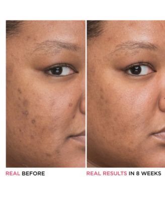 Bye Bye Dark Spots 4% Niacinamide Concentrated Derma Serum