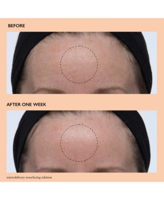 Microdelivery Resurfacing Solution