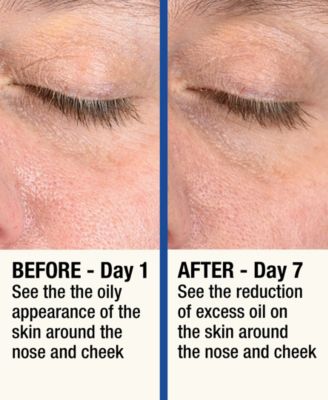 ReMOVE Micro Dermabrasion Device with Cooling Surface