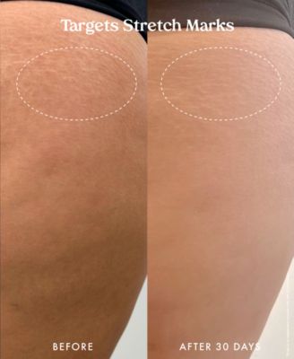 Ultra Renewal Retinol Body Cream, 4.7 oz.