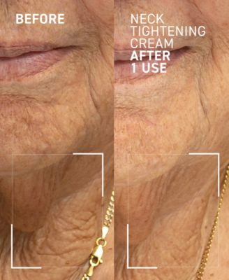 Needles No More Neck Tightening Cream, 1.7 oz.