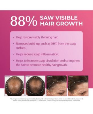 WOMEN's Hair Re-growth Foam 5% Minoxidil