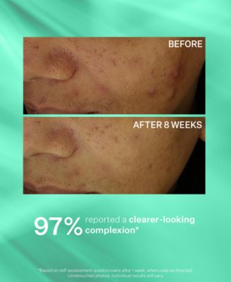 3-Pc. Acne Control Trial Set