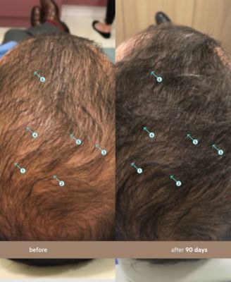 Spectral.DNC-N Hair Density Serum With Nanoxidil 5%, 3-Month Supply