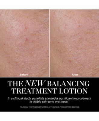 The Balancing Treatment Lotion, 5 oz.