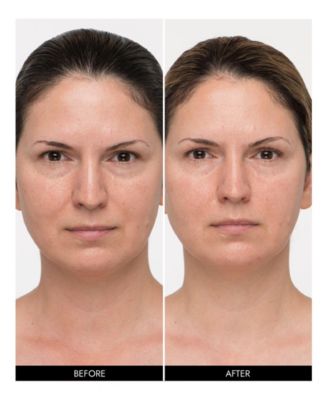 MyoLift Mini Microcurrent Device