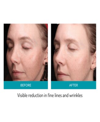 Mask LED Phototherapy Mask