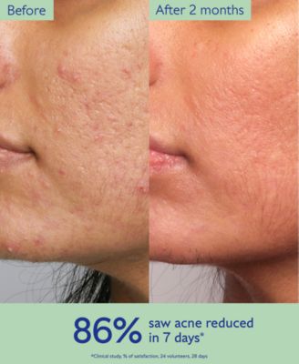 Vinopure Treat and Prevent Blemishes Acne Serum, 1 oz.