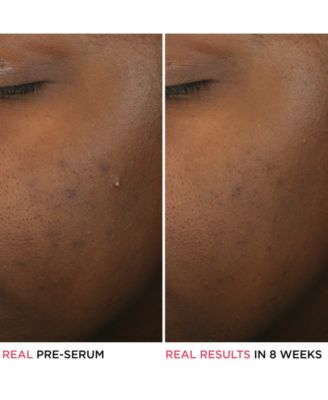 Bye Bye Breakout Serum