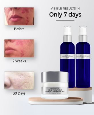 Acne Treatment with UV Chromophores
