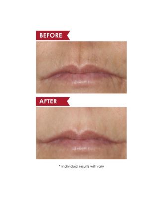 SMOOTH UPPER LIP PROFESSIONAL Perioral Anti-Aging Treatment