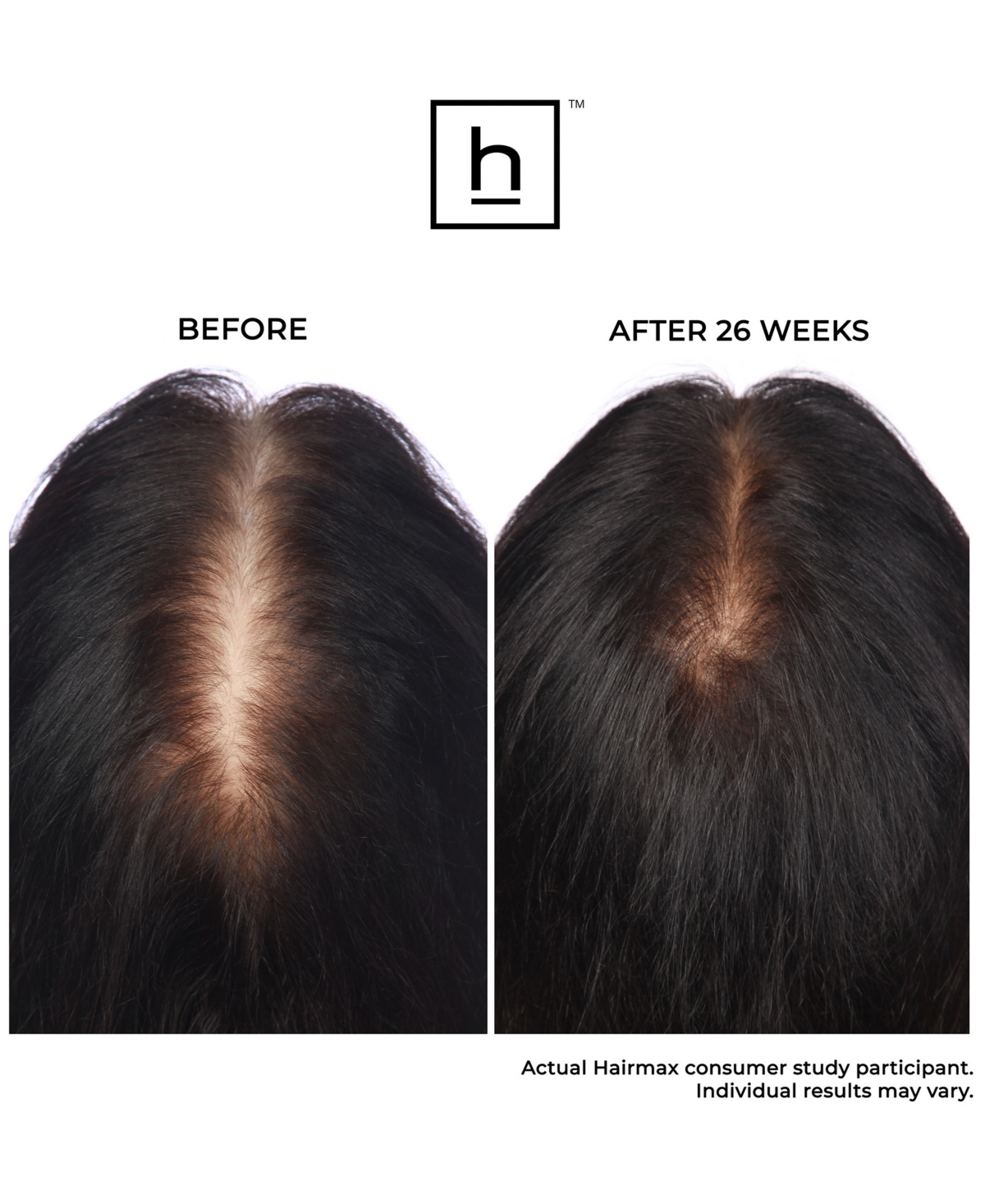 Hairmax Ultima 9 Classic Lasercomb