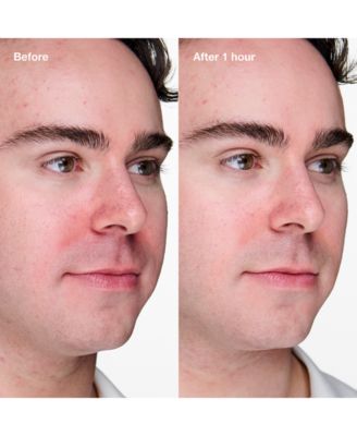 Acne Solutions Clinical Advanced Clearing Gel With Salicylic Acid, 20 ml