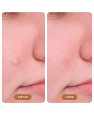 Hydrocolloid Overnight Pimple Patches – 224 Ct Mega Pack, Silk-Backed