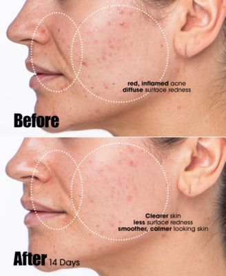 Peacekeeper Acne Treatment Serum, 1 oz.