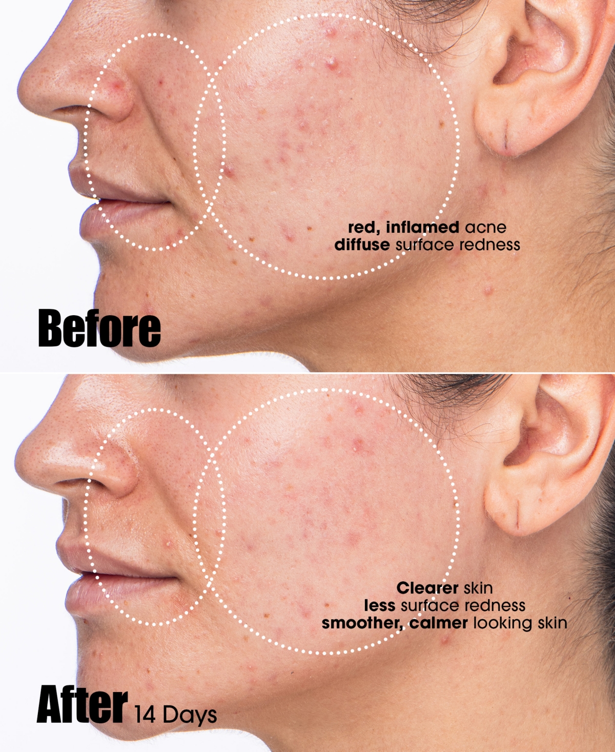 Sunday Riley Peacekeeper Acne Treatment Serum, 1 Oz. In Transparent