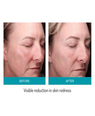 Mask LED Phototherapy Mask